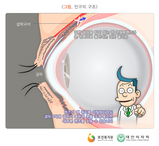 렌즈 눈뒤로.jpg